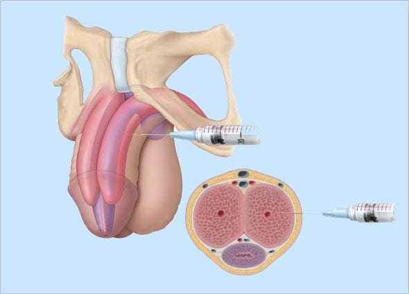 P-SHOT & O-SHOT FOR SEXUAL REJUVENATION