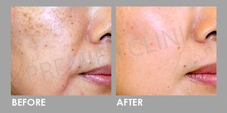 PICO Before After 01