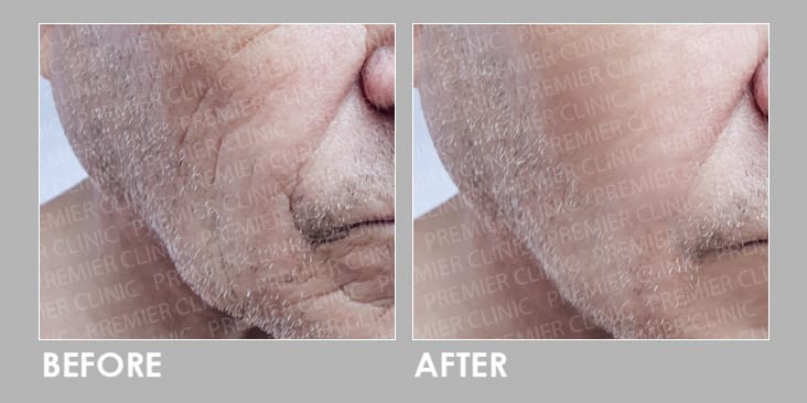 Before & After Profhilo Injection