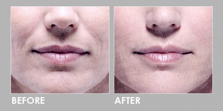 Before & After Profhilo Injection