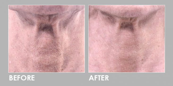 Before & After Profhilo Injection