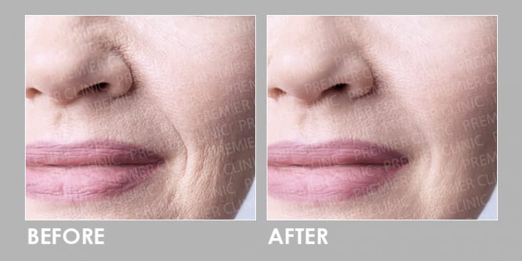 Before & After Profhilo Injection