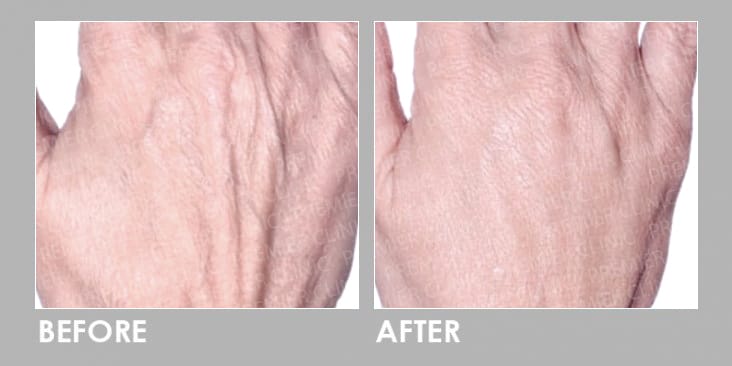 Before & After Profhilo Injection