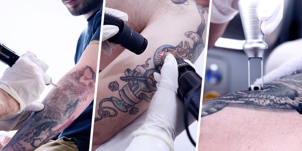 Pico LasePico Laser For Tattoo Removal