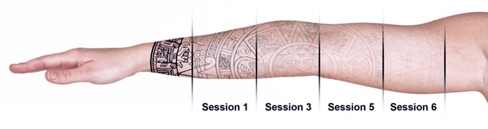 Pico LasePico Laser For Tattoo Removal