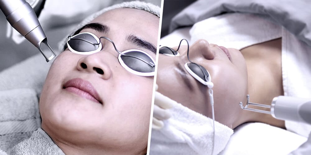 Premier Pico Laser for Acne Scar