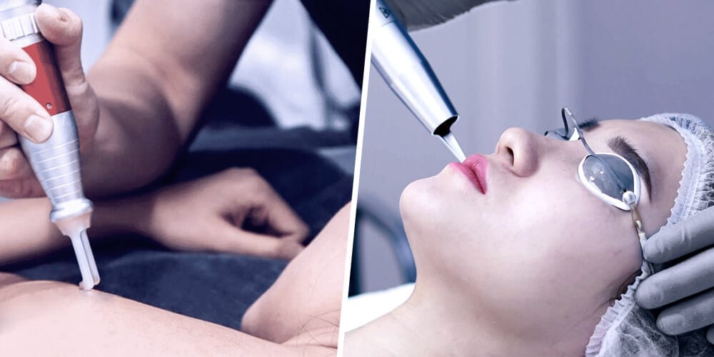Q-Switch Laser for Spider Vein