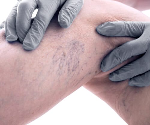 Non-Surgical, Non-Stitching