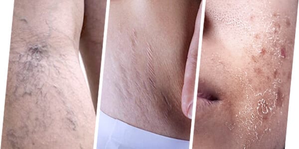 Q-SWITCH LASER IS SUITABLE TO TREAT