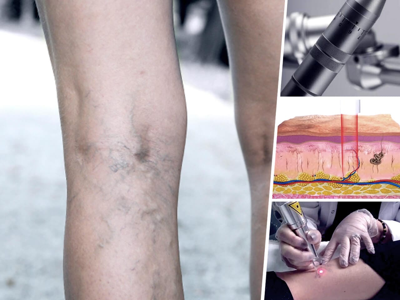 Get Rid Of Spider Vein Permanently With Premier Q-Switch Laser