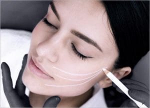 Silhouette Soft Thread Lift