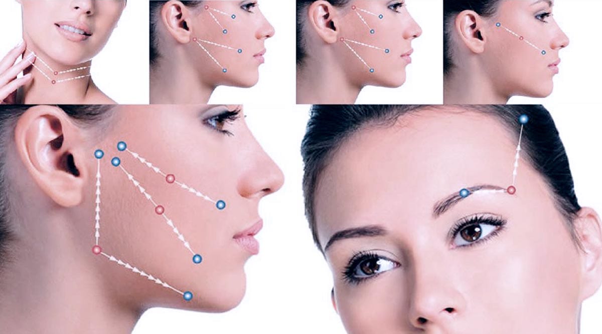Silhouette Soft Thread Lift