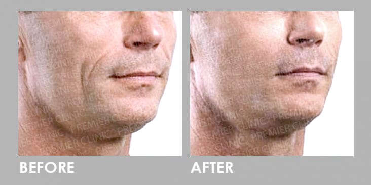 Silhouette Soft Thread Lift