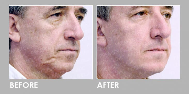 Silhouette Soft Thread Lift