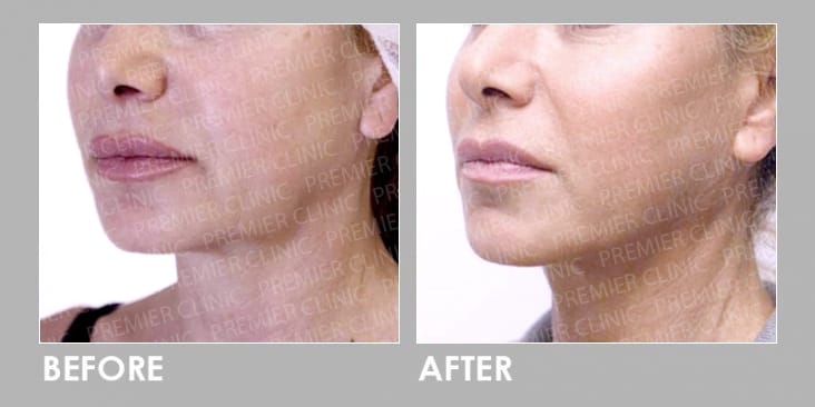 Silhouette Soft Thread Lift