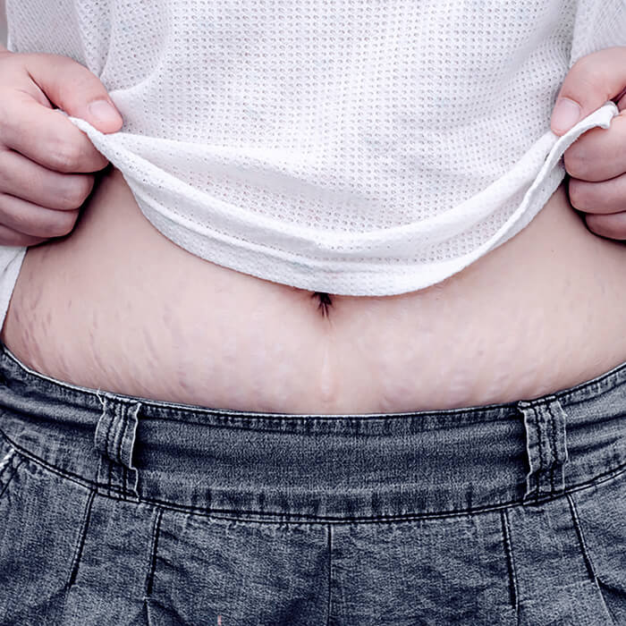 Skin showing visible stretch marks