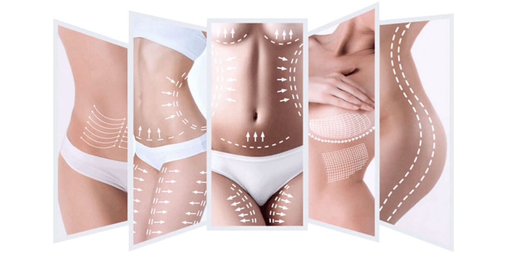 THREAD LIFT