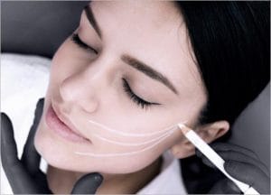 Thread Lift: Non-surgical Skin Lift