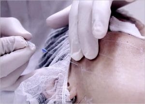 Thread Lift-Non-surgical Skin Lift