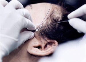 Thread Lift-Non-surgical Skin Lift