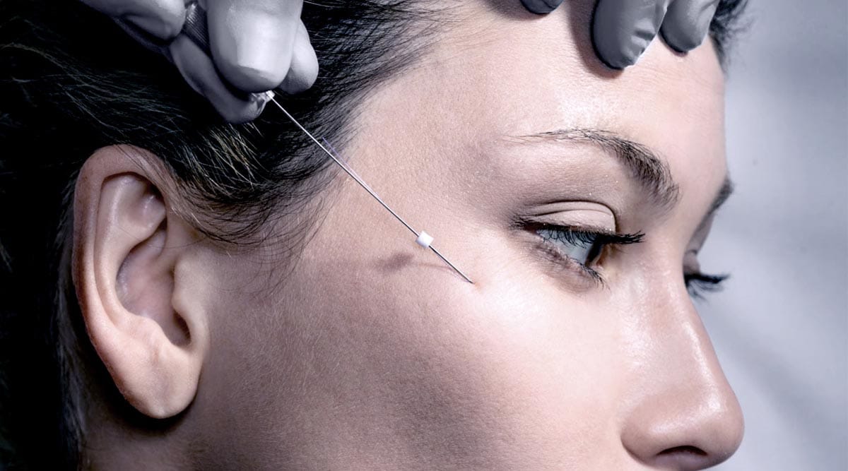 Thread Lift-Non-surgical Skin Lift