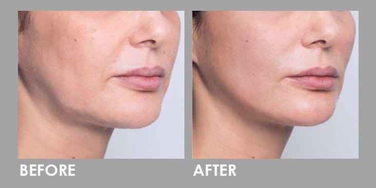 Before & After Thread Lift: Non-surgical Skin Lift