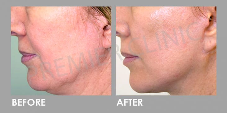 Before & After Thread Lift: Non-surgical Skin Lift