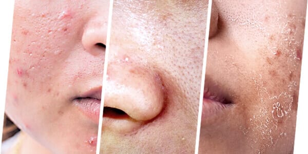 CHEMICAL PEEL IS SUITABLE TO TREAT