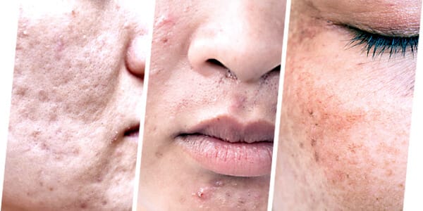 PICO LASER IS SUITABLE TO TREAT
