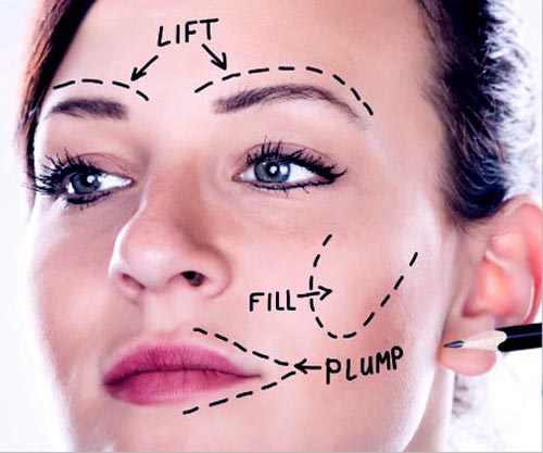 Botulinum Toxin