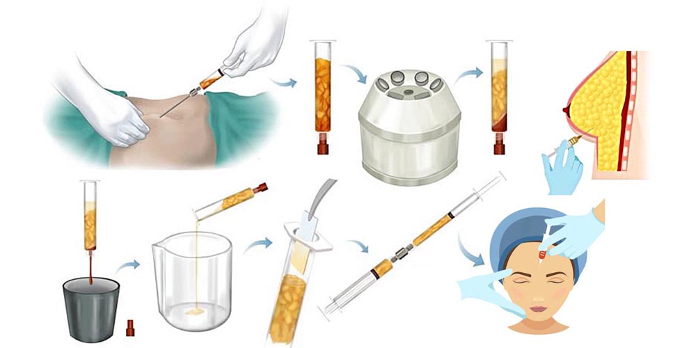Lipocell Body Reshaping