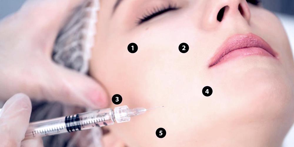 Profhilo Bio-Remodelling Anti Aging 