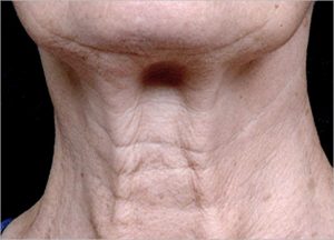 SAGGY Turkey Neck 