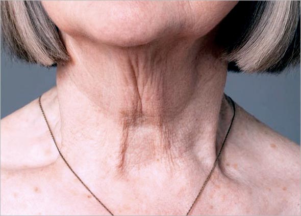 SAGGY Turkey Neck