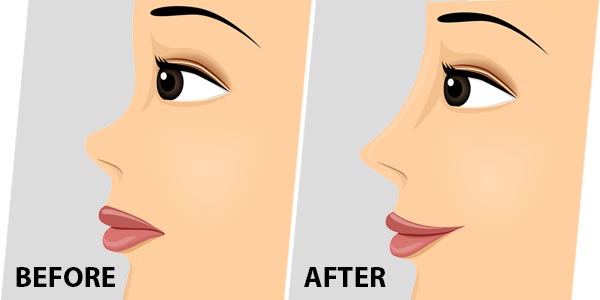 nose condition