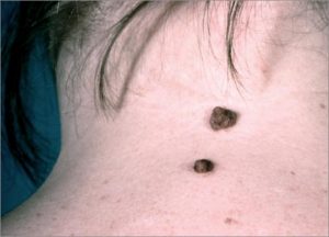 Skin Mole Removal 