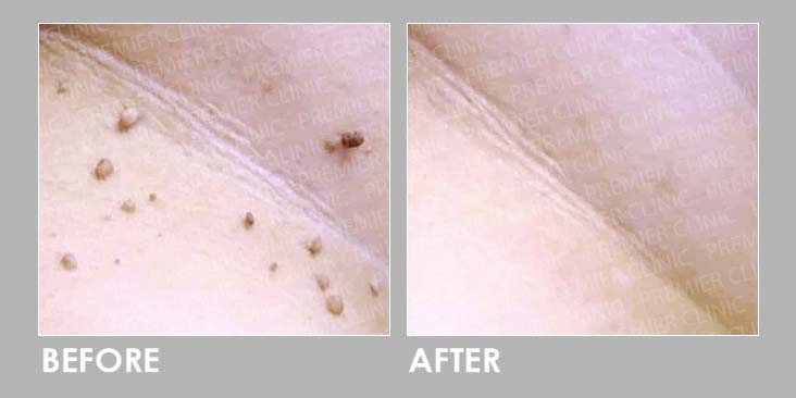 Electrocautery (EC) Treatment
