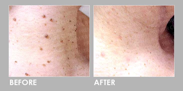 Electrocautery (EC) Treatment