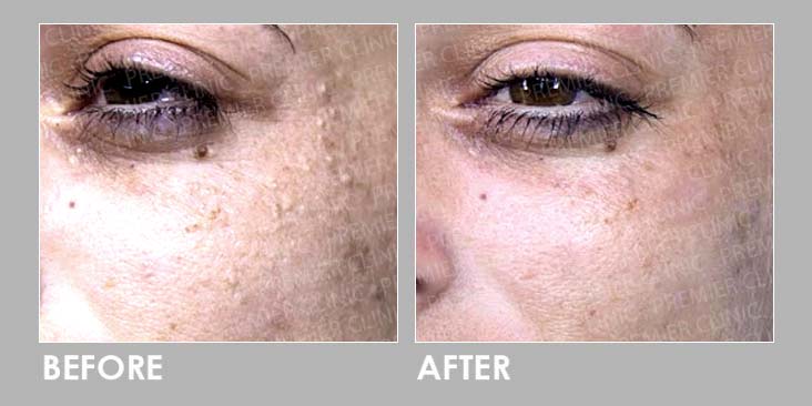 Electrocautery (EC) Treatment