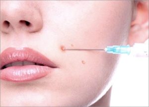 Intralesion Corticosteroid Injection