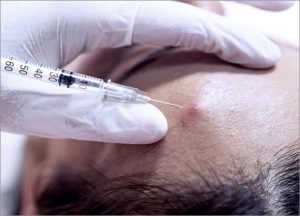 Intralesion Corticosteroid Injection