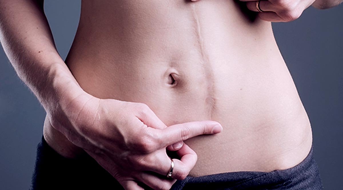 KELOID LASER