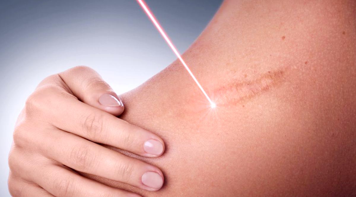 KELOID LASER