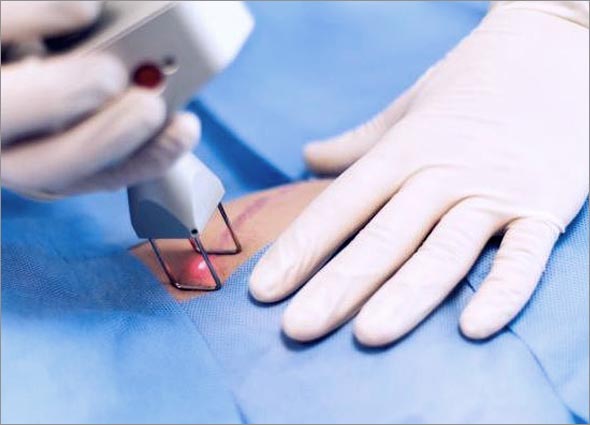 KELOID LASER