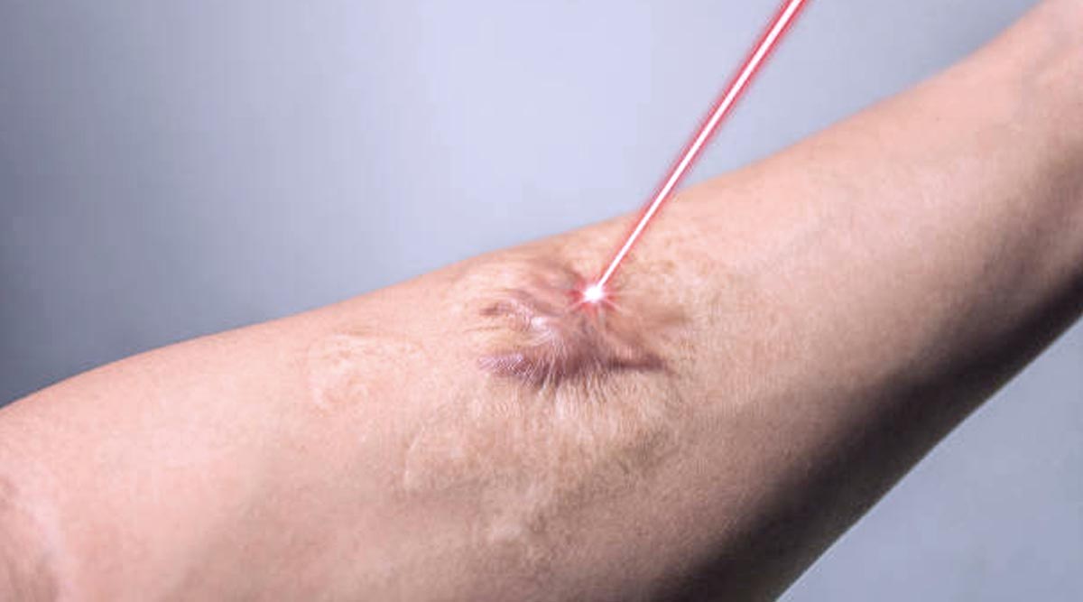 KELOID LASER