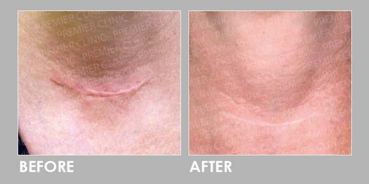 Keloid Laser Treatment Before After