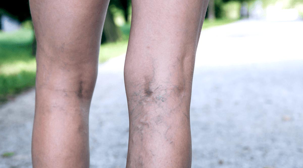 Sclerotherapy Injection