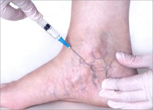 Sclerotherapy Injection