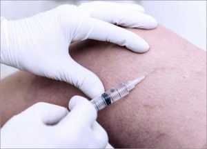 Sclerotherapy Injection