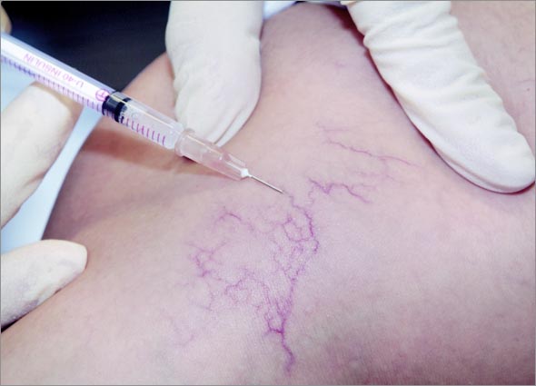 Sclerotherapy Injection